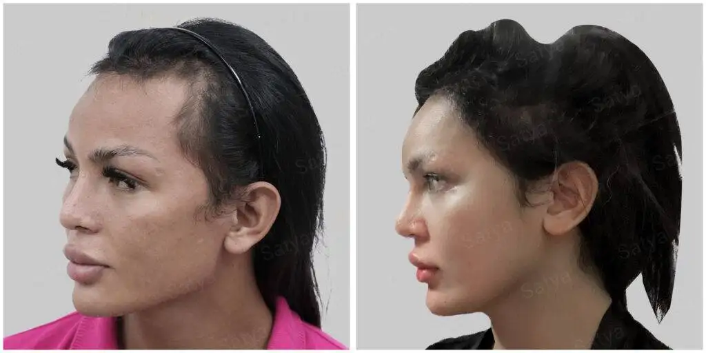 Hair transplant result