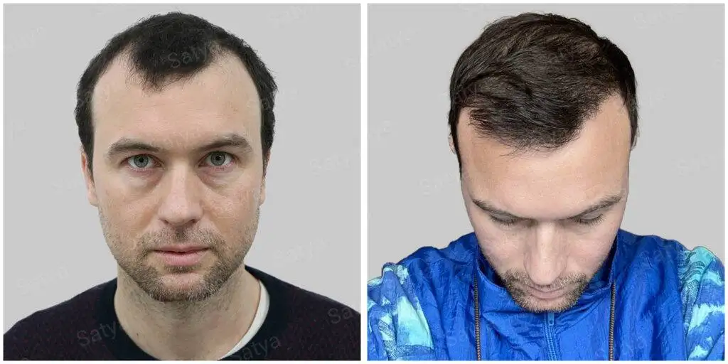Adam from Sweden — before and after
